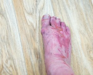Poor Circulation causing foot pain