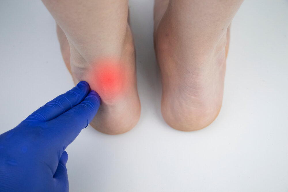 Achilles Tendonitis, An Orthopedic Doctor Examines A Woman's Leg.